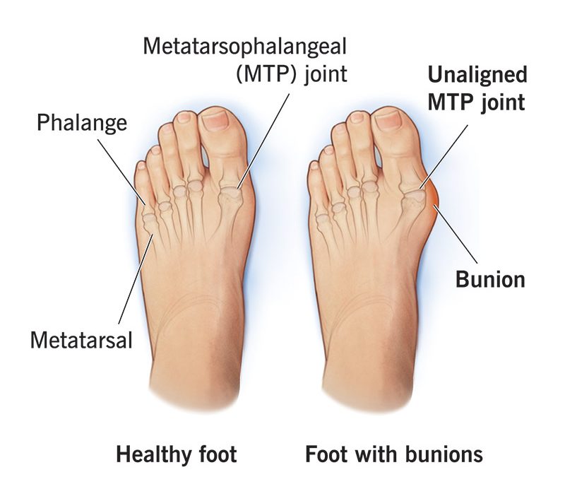 Bunions