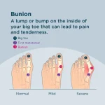 Bunions, foot problems corrective metatarsal problems and remedies